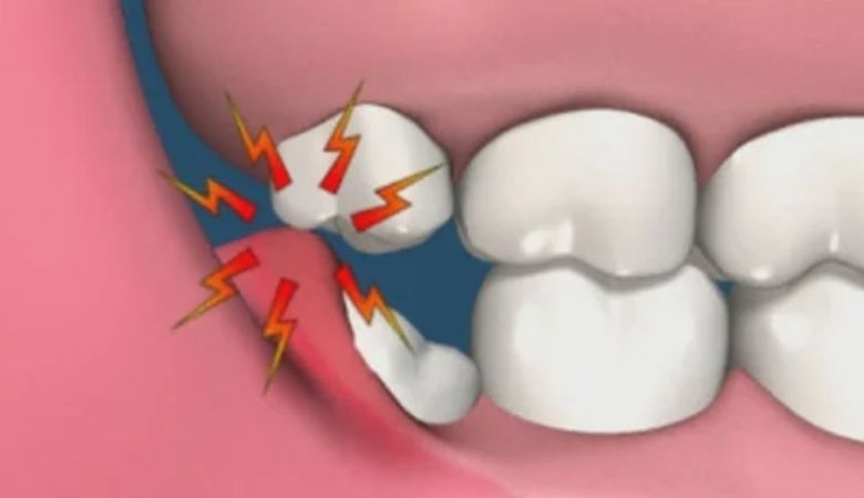 Hàm nặng nề cử động khó khăn