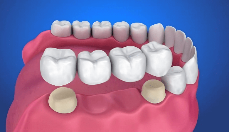 Dựa vào tình trạng răng miệng để trồng răng sứ