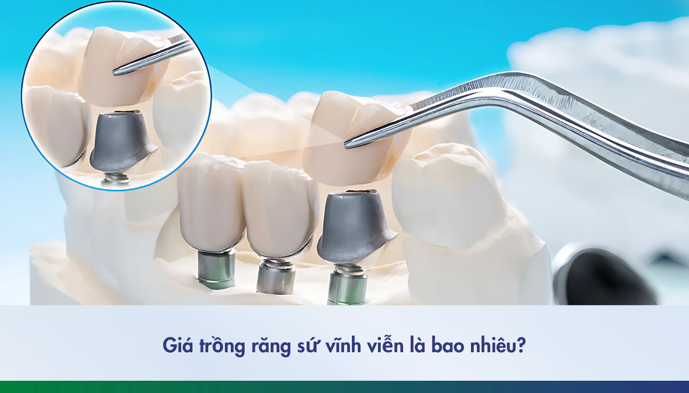 Trồng răng sứ vĩnh viễn bao nhiêu