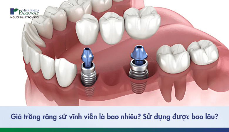 giá trồng răng sứ vĩnh viễn