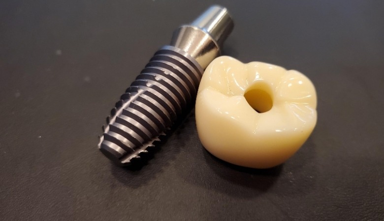 Phương pháp trồng răng implant