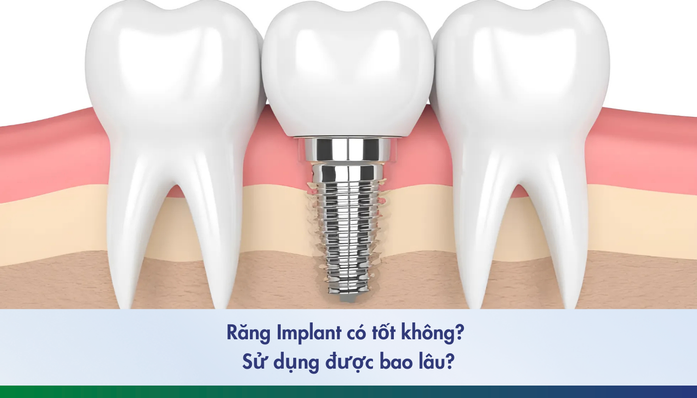 Răng Implant có tốt không? Dùng được bao lâu?