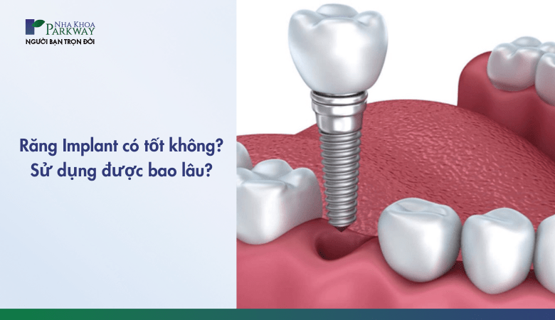 Răng Implant có tốt không? Dùng bao lâu?