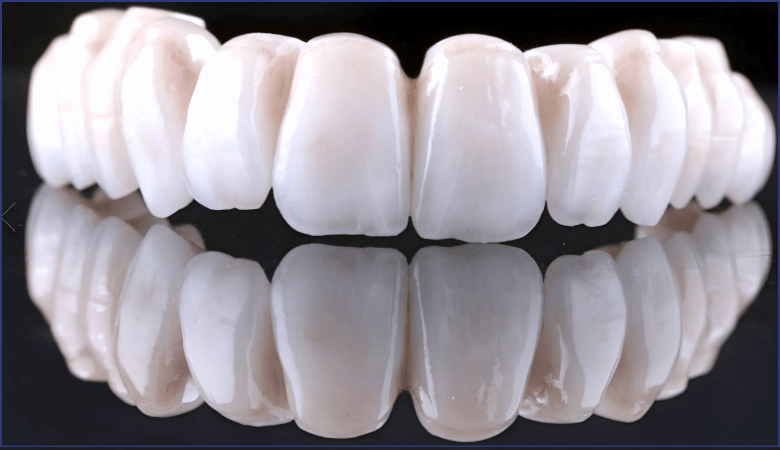 răng sứ toàn sứ