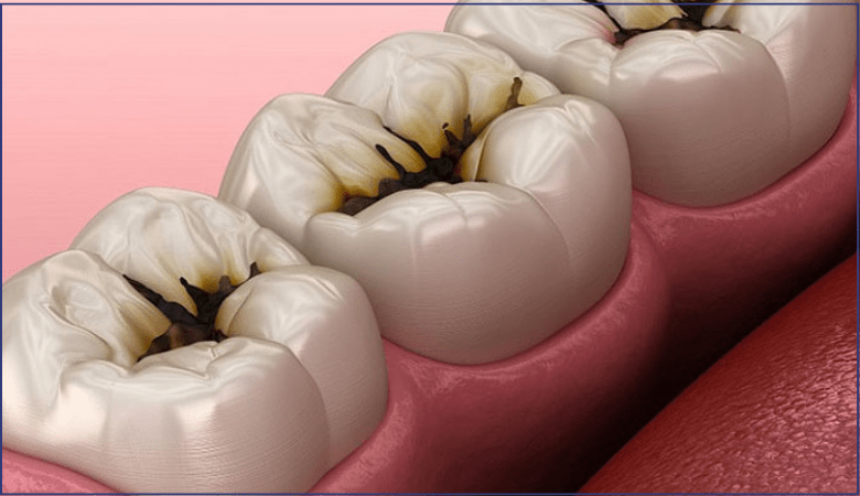 nguyên nhân gây đau răng