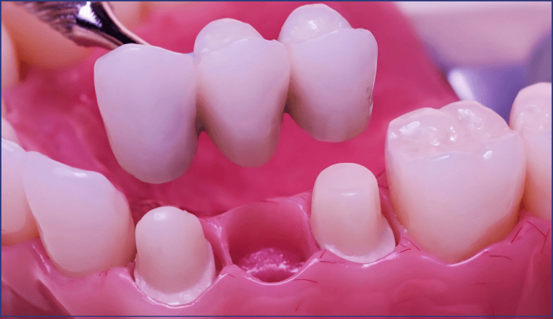 Số lượng răng cần làm