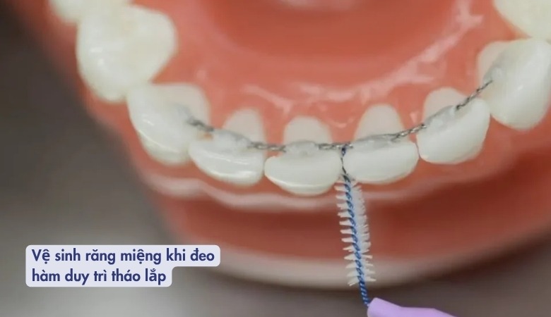 Sử dụng bàn chải chuyên dụng để vệ sinh răng miệng khi đeo hàm duy trì cố định