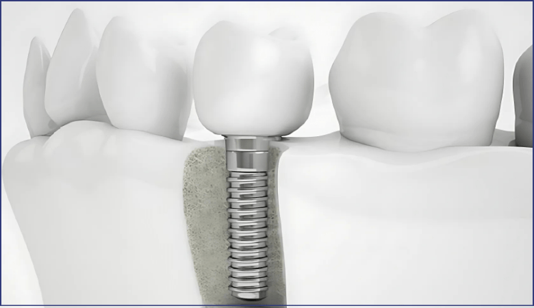 hạn chế tiêu xương khi trồng răng implant