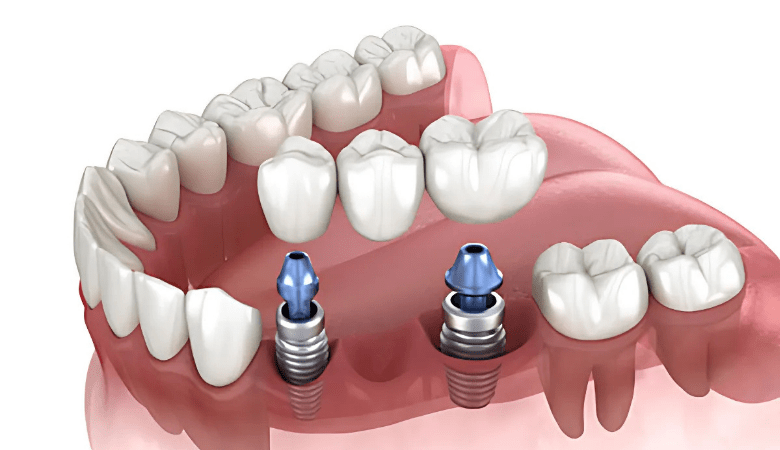 Trồng răng vĩnh viễn với phương pháp Implant