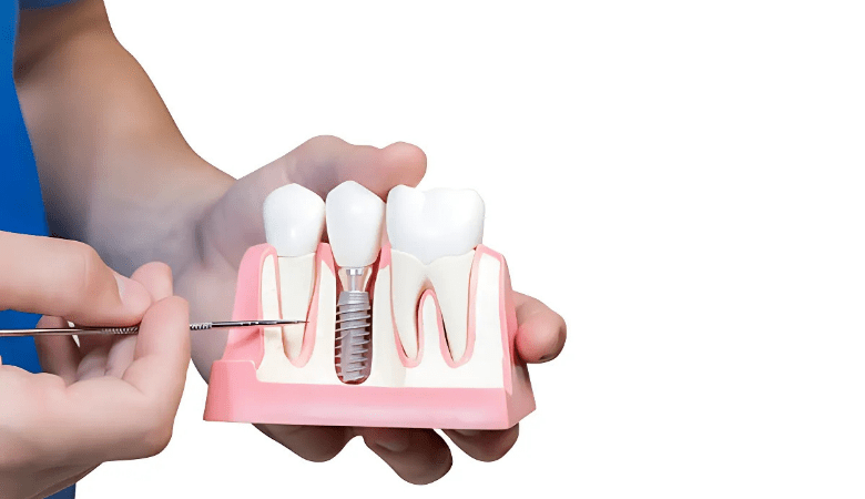 trồng răng sứ vĩnh viễn là gì