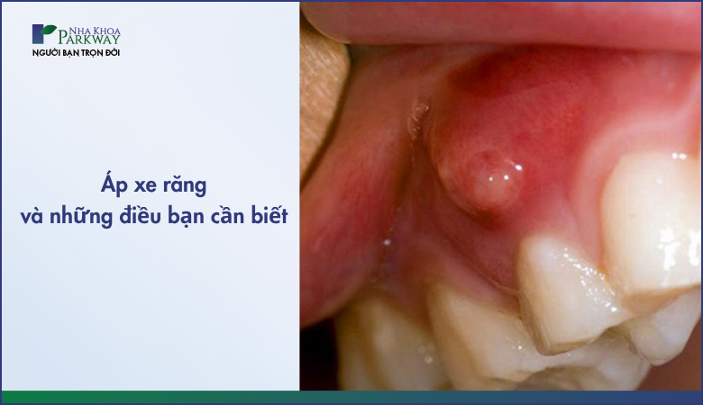 áp xe răng và những điều bạn cần biết