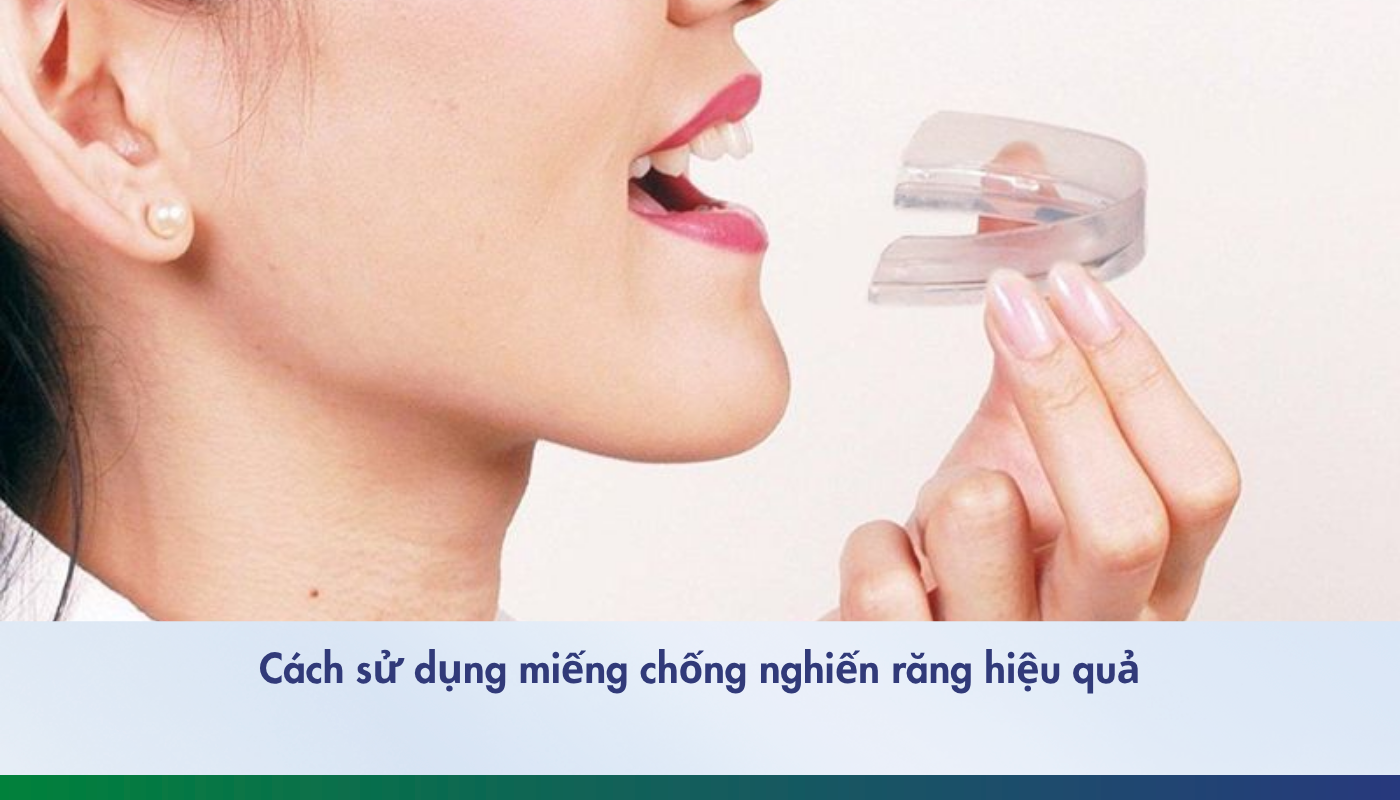 hướng dẫn dùng máng chống nghiền răng