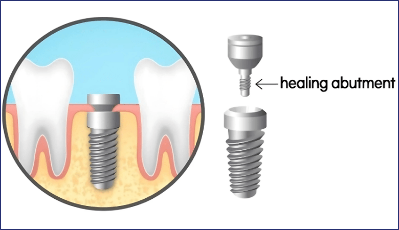 Chất liệu healing
