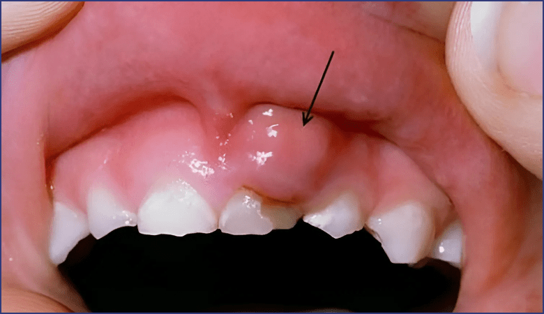 Dấu hiệu sưng nướu răng