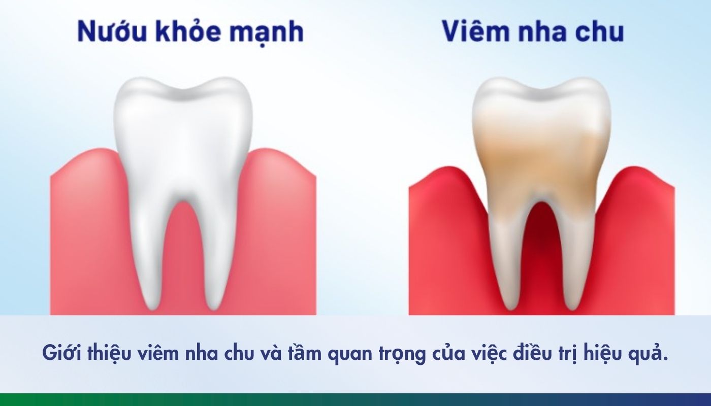 Giới thiệu viêm nha chu và tầm quan trọng của việc điều trị hiệu quả.