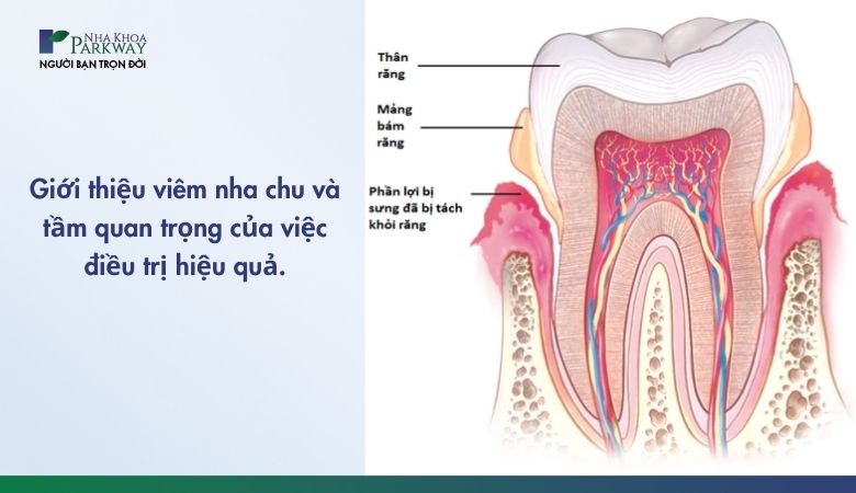 Viêm nha chu là một bệnh lý răng miệng phổ biến