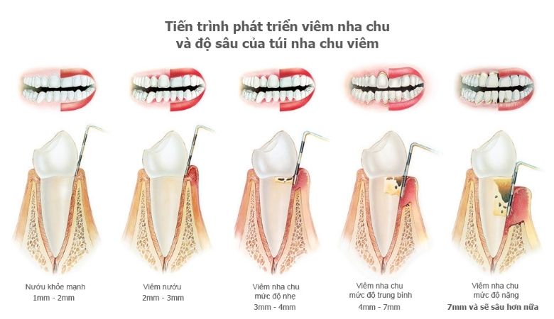 viêm nha chu chủ yếu là do sự tích tụ của mảng bám và cao răng