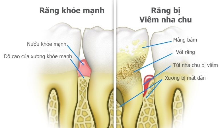 Trong trường hợp viêm nha chu nặng, phẫu thuật như ghép nướu hoặc tái tạo xương có thể được chỉ định
