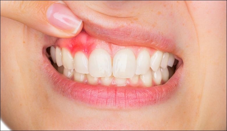 Lấy cao răng và làm sạch bề mặt răng là bước đầu tiên trong điều trị viêm nha chu giai đoạn nhẹ