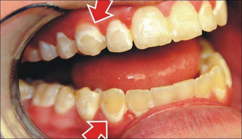 Nếu không điều trị, bệnh có thể gây tiêu xương ổ răng, dẫn đến mất răng vĩnh viễn.