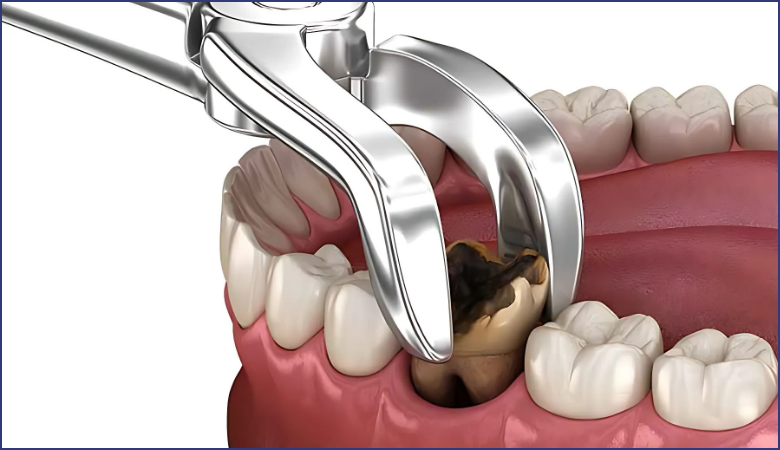 giá nhổ răng sâu