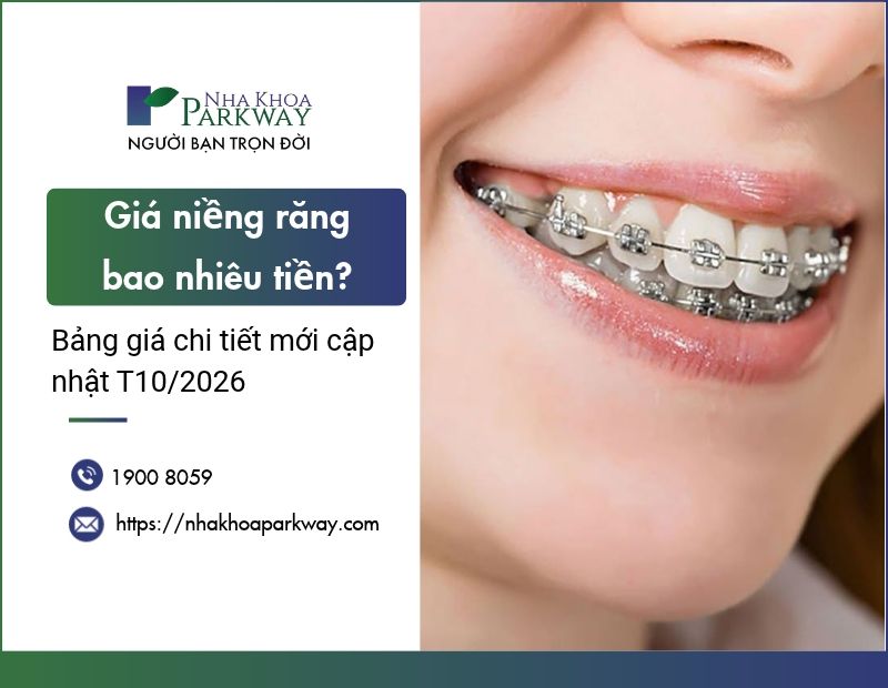Giá niềng răng bao nhiêu tiền