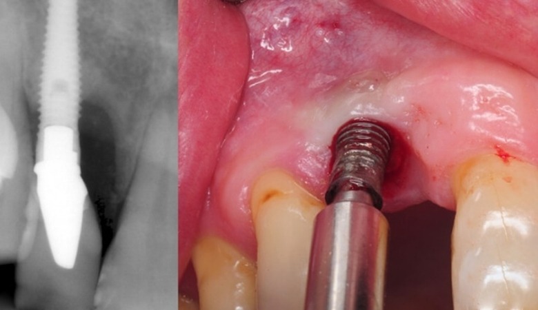 Hối hận khi trồng implant giá rẻ gây viêm nhiễm