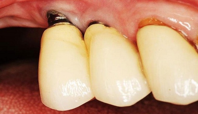 Trụ implant giá rẻ không đạt chuẩn bị đào thải