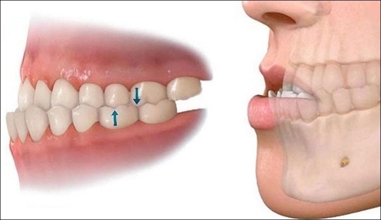 Trồng răng implant kém chất lượng có thể gây sai lệch khớp cắn