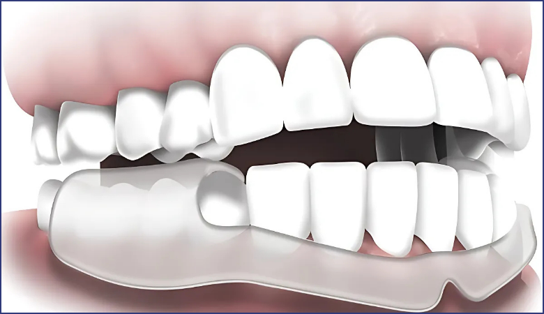 máng chống nghiến răng là gì