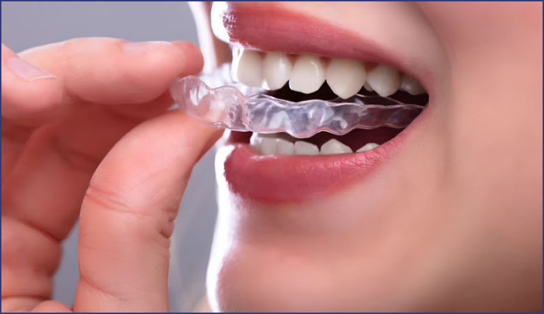 lợi ích máng chống nghiến răng