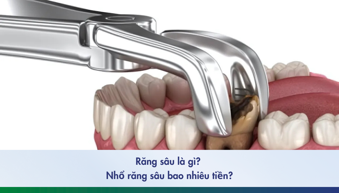 nhổ răng sâu bao nhiêu tiền