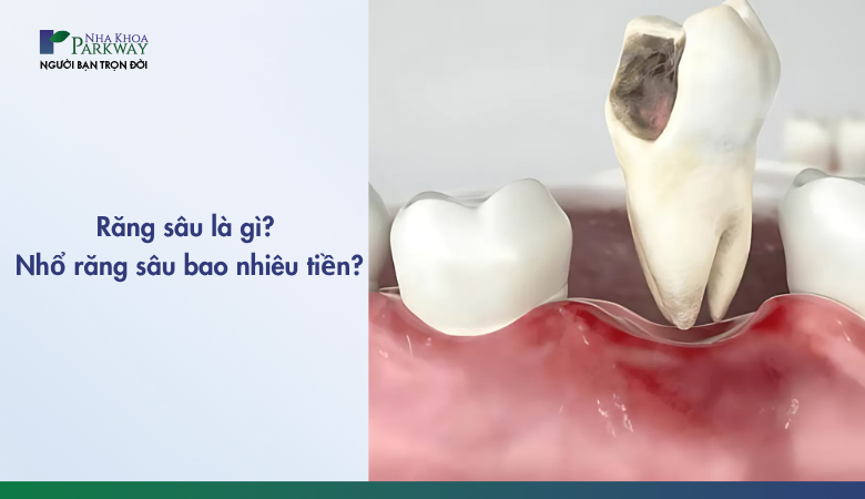 nhổ răng sâu bao nhiêu tiền