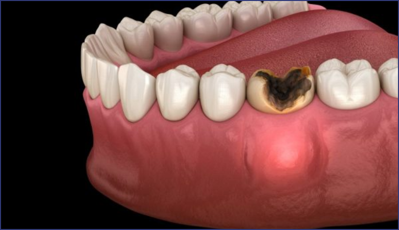 Răng sâu là gì? Nhổ răng sâu bao nhiêu tiền?