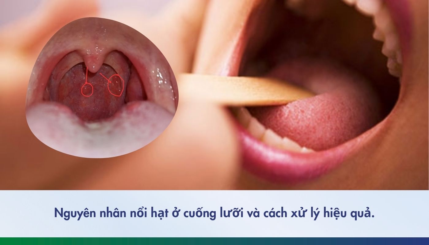 Nguyên nhân nổi hạt ở cuống lưỡi và cách xử lý hiệu quả
