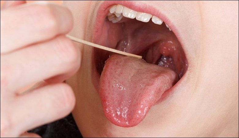 Hình ảnh nổi hạt ở cuống lưỡi - 9