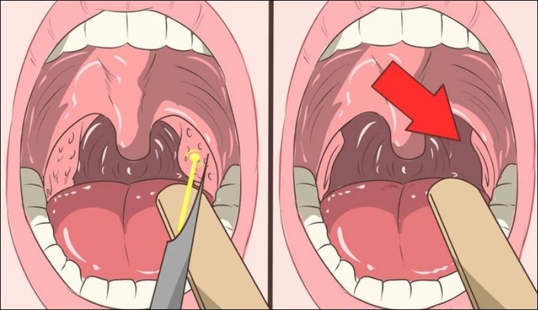 Điều trị kịp thời giúp giảm triệu chứng và ngăn ngừa biến chứng