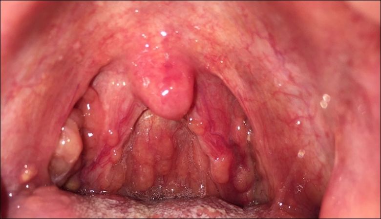 Hình ảnh nổi hạt ở cuống lưỡi - 10