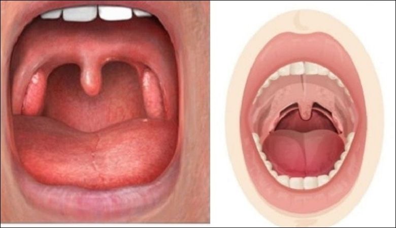 Nhiễm virus như HPV hoặc vi khuẩn liên cầu khuẩn có thể gây ra các nốt sần ở cuống lưỡi