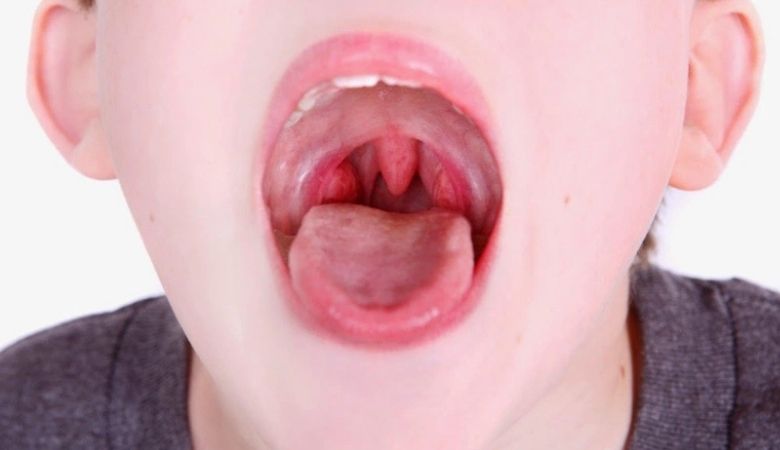 Phòng ngừa nổi hạt ở cuống lưỡi bắt đầu từ việc duy trì vệ sinh răng miệng