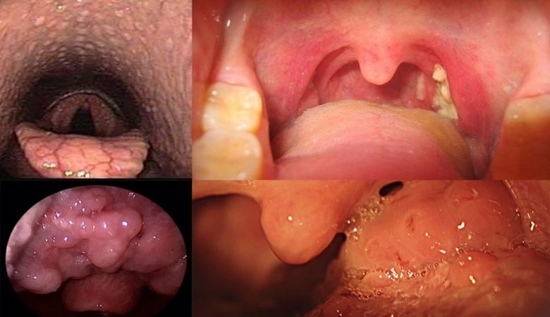 Hình ảnh nổi hạt ở cuống lưỡi - 1