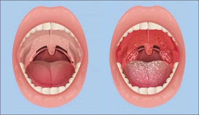Hình ảnh nổi hạt ở cuống lưỡi