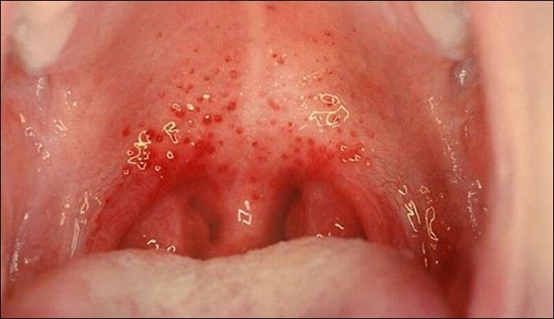 Hình ảnh nổi hạt ở cuống lưỡi