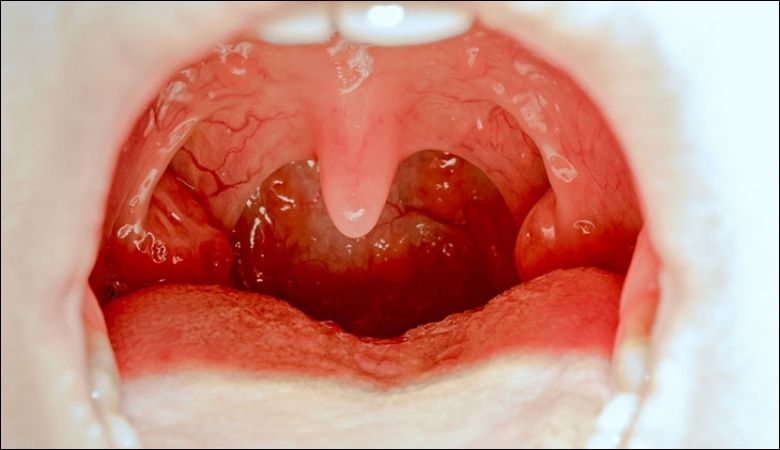 Hình ảnh nổi hạt ở cuống lưỡi