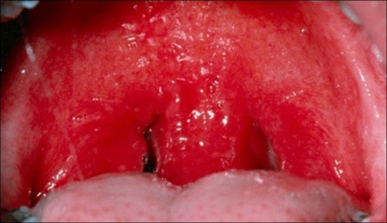 Hình ảnh nổi hạt ở cuống lưỡi - 5