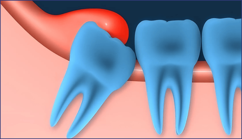 Răng khôn mọc lệch