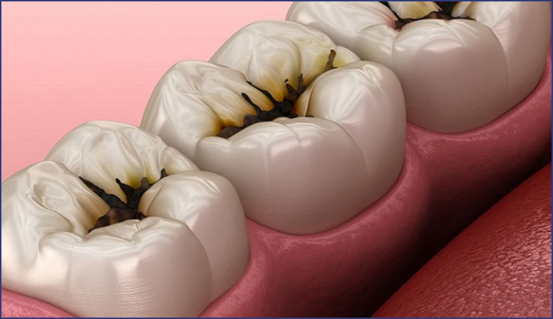 răng sâu là gì