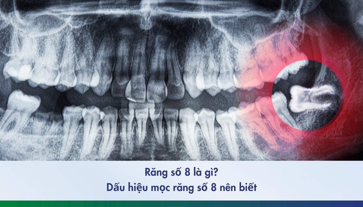 Tìm hiểu về răng số 8