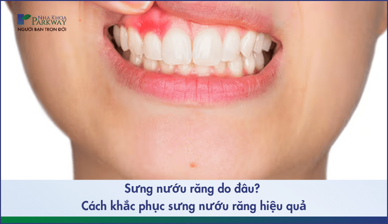 Sưng nướu răng do đâu