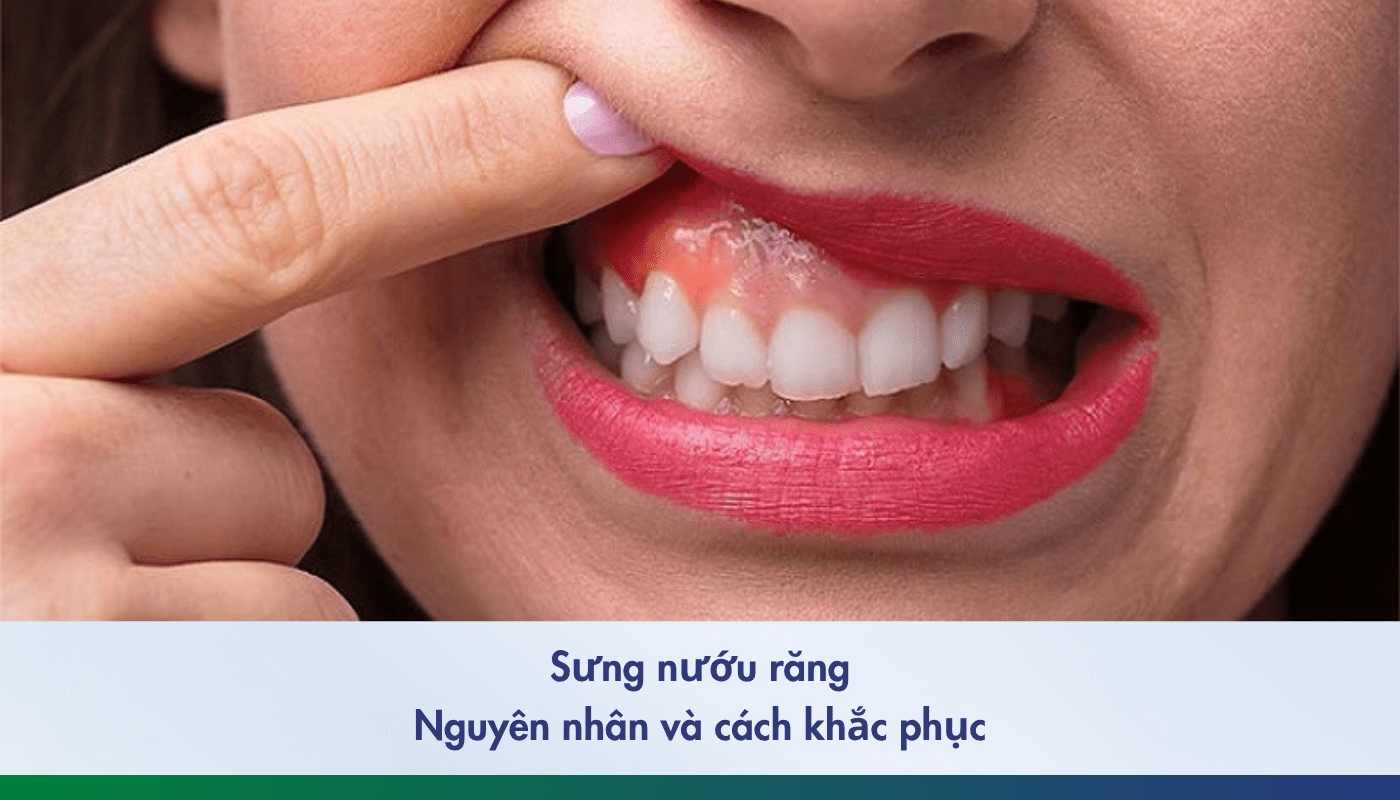 Sưng nướu răng: Nguyên nhân và cách khắc phục